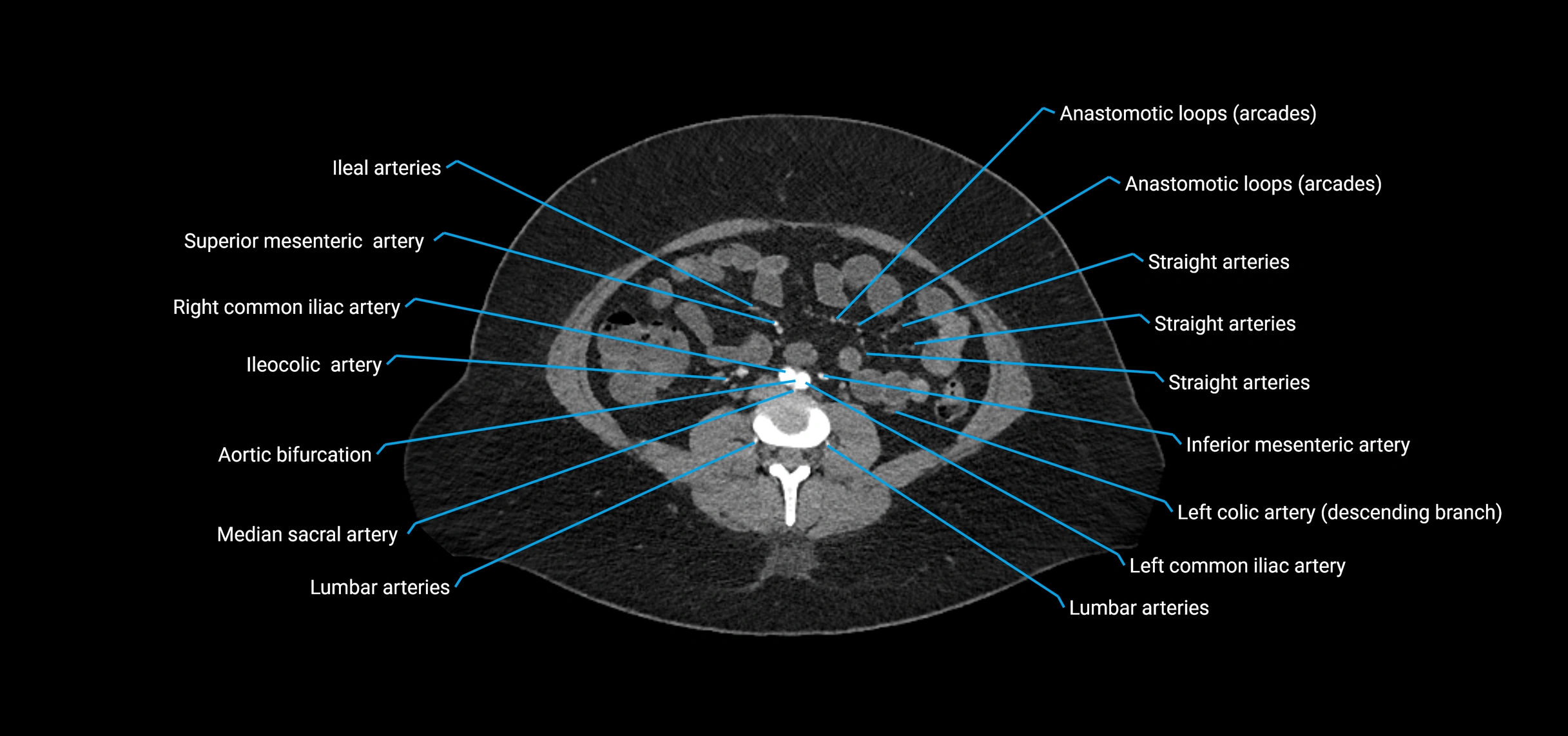CTA abdomen axial cross sectional anatomy labelled image_124 (2).webp